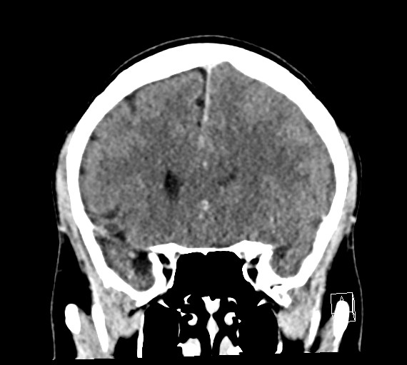 Cerebral metastases - testicular choriocarcinoma (Radiopaedia 84486-99855 D 21).jpg