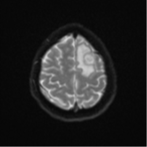 File:Cerebral metastases mimicking abscesses (Radiopaedia 45841-50131 Axial DWI 24).png