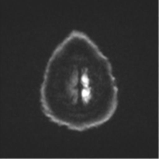 Cerebral metastases mimicking multifocal glioblastoma (Radiopaedia 50843-56353 Axial DWI 54).png