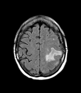 File:Cerebral metastasis (Radiopaedia 46744-51248 Axial FLAIR 22).png