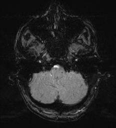 Cerebral metastasis - melanoma (Radiopaedia 54718-60954 Axial SWI 9).png