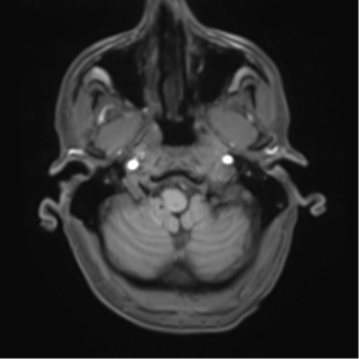 Cerebral metastasis - melanoma (Radiopaedia 54718-60954 Axial T1 9).png