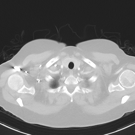 File:Cerebral metastasis mimicking glioblastoma (Radiopaedia 69155-78938 Axial lung window 1).png