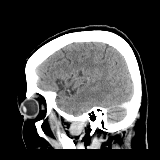 Cerebral metastasis to basal ganglia (Radiopaedia 81568-95412 Sagittal C+ delayed 44).png