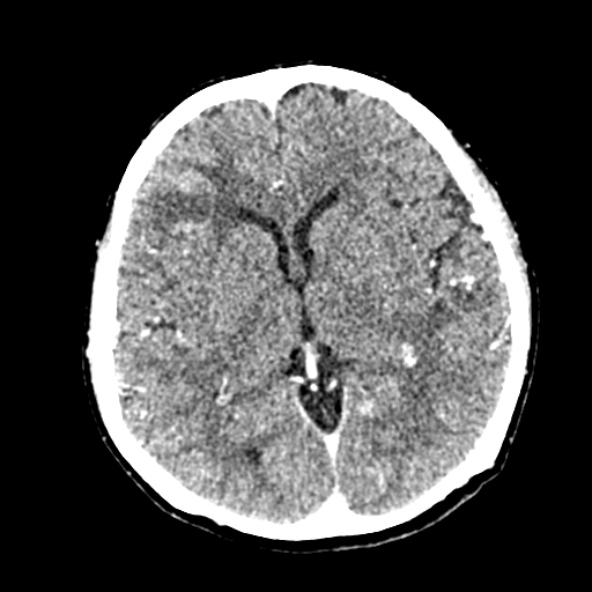 Cerebral ring enhancing lesions - cerebral metastases (Radiopaedia 44922-48818 B 146).jpg