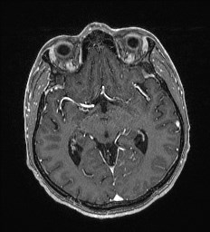 Cerebral toxoplasmosis (Radiopaedia 43956-47461 Axial T1 C+ 31).jpg