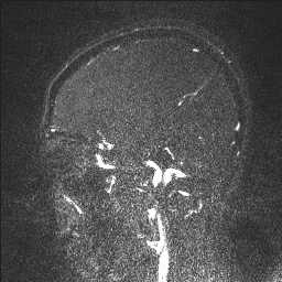 Cerebral tuberculosis with dural sinus invasion (Radiopaedia 60353-68090 Sagittal MRV 42).jpg