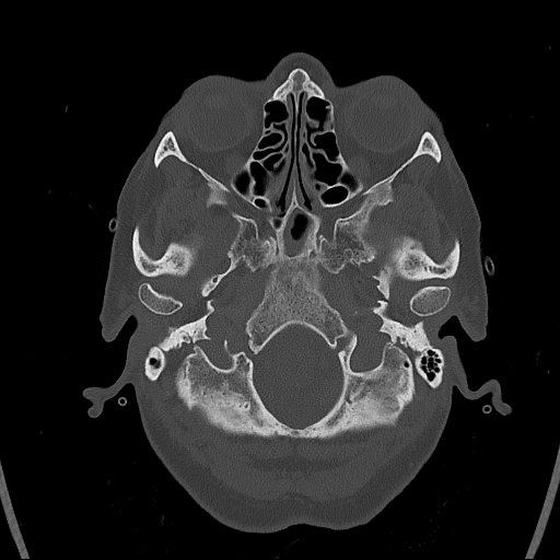 Cerebral venous infarction with hemorrhage (Radiopaedia 65343-74381 Axial bone window 9).jpg