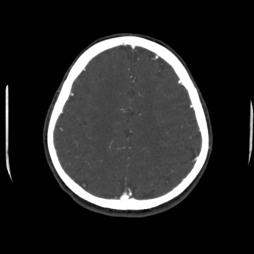 Cerebral venous sinus thrombosis (Radiopaedia 40619-43227 A 173).jpg