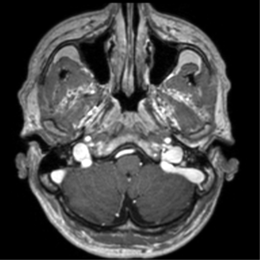 Cerebral venous thrombosis (Radiopaedia 38392-40469 Axial T1 C+ 15).png