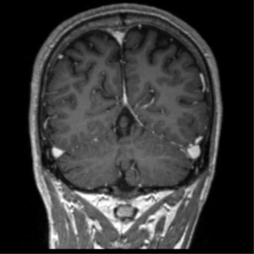 Cerebral venous thrombosis (Radiopaedia 38392-40469 Coronal T1 C+ 22).png