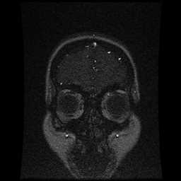 Cerebral venous thrombosis - ulcerative colitis (Radiopaedia 66049-75219 Coronal MRV 101).jpg