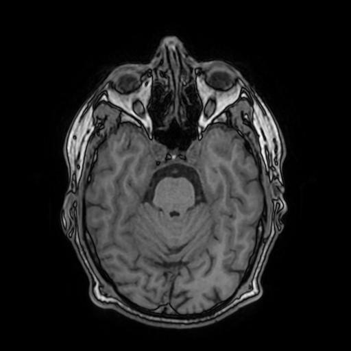 File:Cerebral venous thrombosis with secondary intracranial hypertension (Radiopaedia 89842-106957 Axial T1 68).jpg