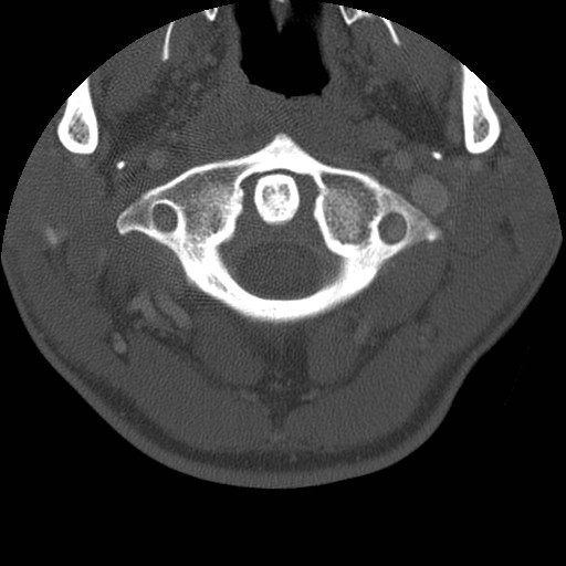 Cervical Pott disease (Radiopaedia 20374-20286 Axial bone window 24).jpg