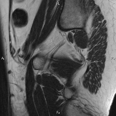 File:Cervical adenocarcinoma (Radiopaedia 65011-73985 Sagittal T2 2).jpg