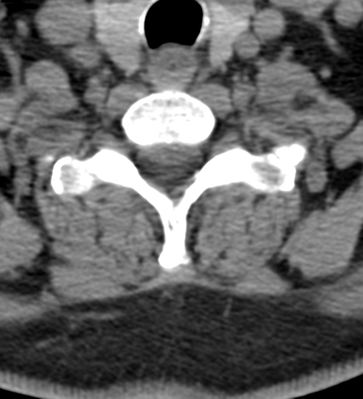 Cervical canal stenosis due to ossification of the posterior longitudinal ligament (Radiopaedia 47260-51823 Axial non-contrast 49).png