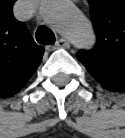 Cervical canal stenosis due to ossification of the posterior longitudinal ligament (Radiopaedia 47260-51823 Axial non-contrast 71).png