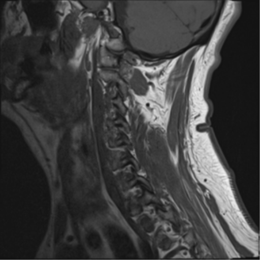 File:Cervical canal stenosis due to ossification of the posterior longitudinal ligament (Radiopaedia 47260-51824 Sagittal T1 13).png