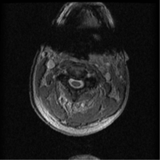 File:Cervical canal stenosis with cord compression (Radiopaedia 34114-35374 Axial Gradient Echo 74).png