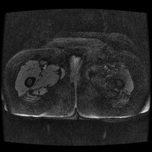Cervical carcinoma (Radiopaedia 70924-81132 Axial T1 C+ fat sat 1).jpg