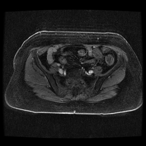File:Cervical carcinoma (Radiopaedia 70924-81132 Axial T1 C+ fat sat 159).jpg