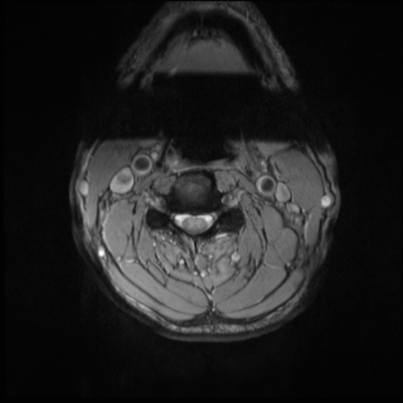 File:Cervical disc extrusion (Radiopaedia 53950-60077 Axial T2 12).jpg