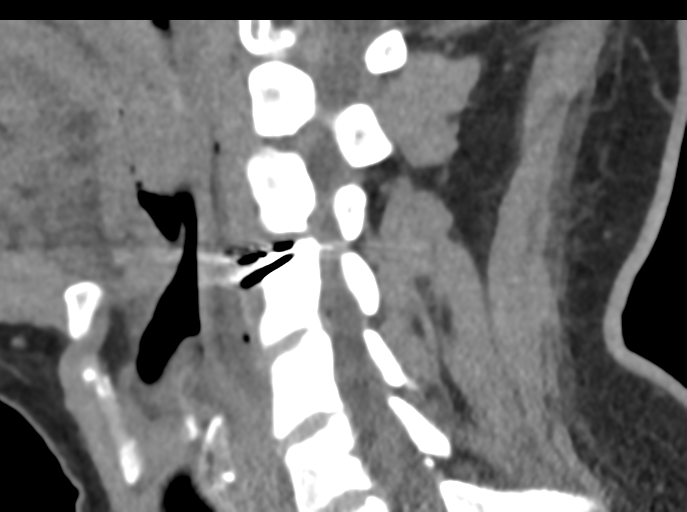 File:Cervical disc replacement (Radiopaedia 44025-47541 B 44).png