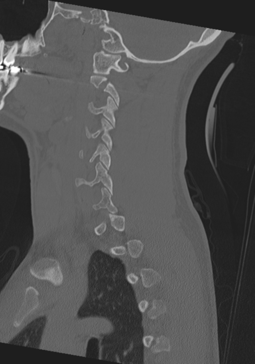 Cervical intercalary bone (Radiopaedia 35211-36748 Sagittal bone window 56).png