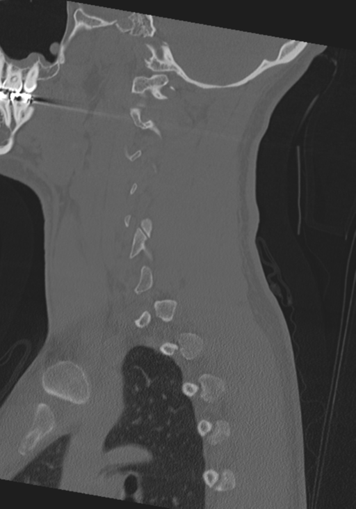 Cervical intercalary bone (Radiopaedia 35211-36748 Sagittal bone window 58).png