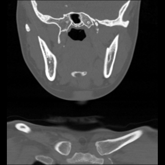 File:Cervical rib (Radiopaedia 71110-81363 Coronal non-contrast 40).jpg