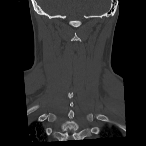 Cervical schwannoma (Radiopaedia 57979-64974 Coronal bone window 44).png