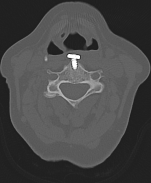 Cervical spine ACDF loosening (Radiopaedia 48998-54071 Axial bone window 29).png