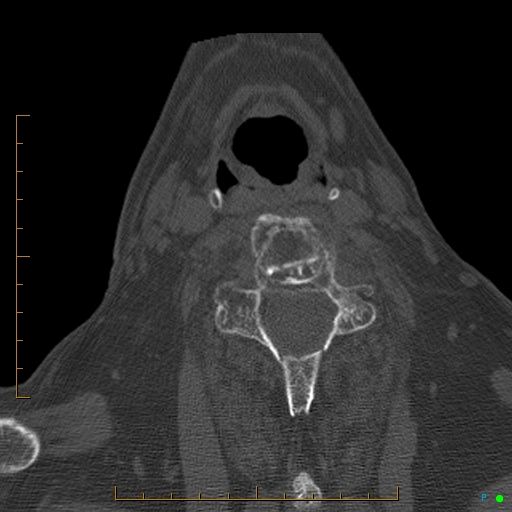 Cervical spine fracture - ankylosing spondylitis (Radiopaedia 76835-88706 Axial bone window 144).jpg