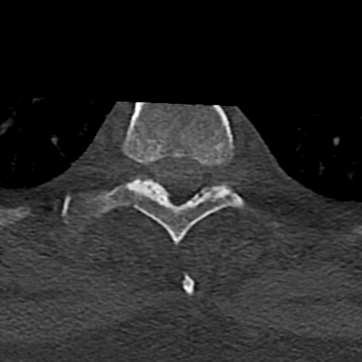 Cervical spine fracture - chalk stick (Radiopaedia 39116-41323 Axial bone window 108).png