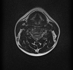 File:Cervical spondylodiscitis and calvarial hemangioma (Radiopaedia 64317-73104 Axial T2 8).jpg