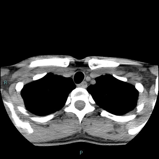 Cervical thymic cyst (Radiopaedia 88632-105335 Axial non-contrast 23).jpg