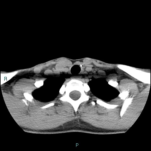 File:Cervical thymic cyst (Radiopaedia 88632-105335 Axial non-contrast 32).jpg