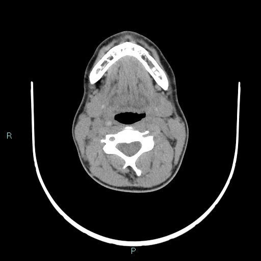 Cervical thymic cyst (Radiopaedia 88632-105335 Axial non-contrast 71).jpg