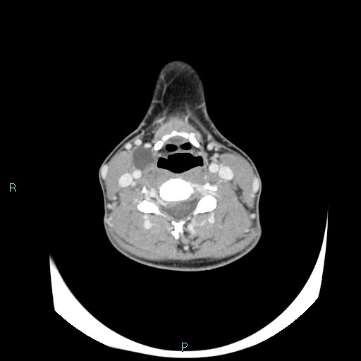 File:Cervical thymic cyst (Radiopaedia 88632-105335 C 60).jpg