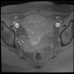 File:Cesarean scar ectopic pregnancy (Radiopaedia 77286-89362 Axial T1 fat sat 15).jpg