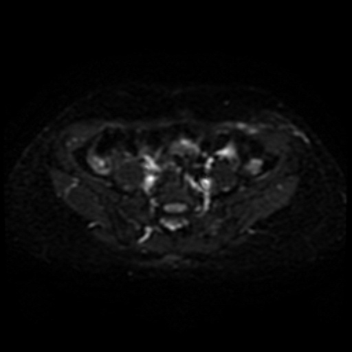 Cesarian section scar endometriosis (Radiopaedia 66520-75799 Axial DWI 3).jpg