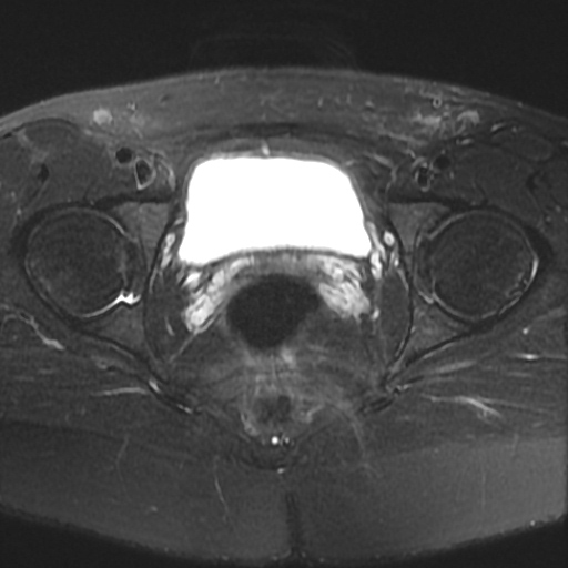 File:Cesarian section scar endometriosis (Radiopaedia 66520-75799 Axial T2 fat sat 19).jpg