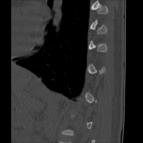 Chance fracture (Radiopaedia 36521-38081 Sagittal bone window 60).jpg