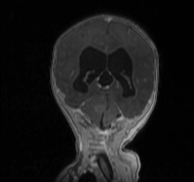 Chiari III malformation with occipital encephalocele (Radiopaedia 79446-92559 Coronal T1 C+ mpr 26).jpg