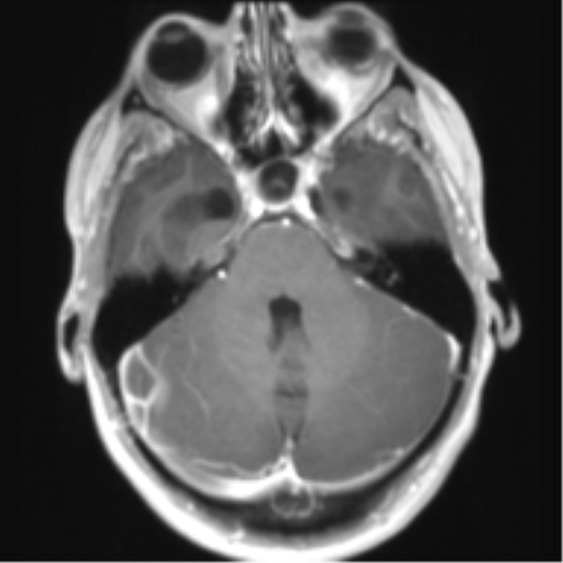File:Chiari I malformation and obstructive hydrocephalus (Radiopaedia 41185-43978 Axial T1 C+ 11).png