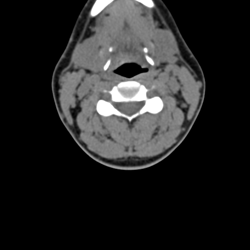 Chiari I malformation and obstructive hydrocephalus (Radiopaedia 41185-43981 D 50).png