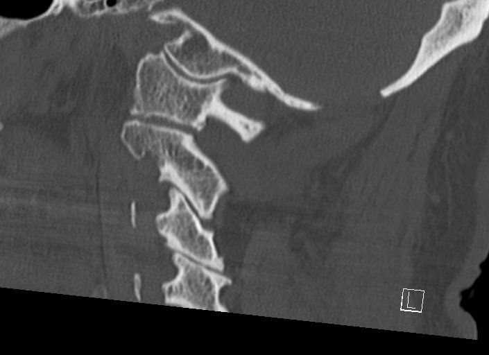 Chiari I malformation with a symptomatic syrinx of the posterolateral medulla oblongata (Radiopaedia 42573-45707 A 21).jpg