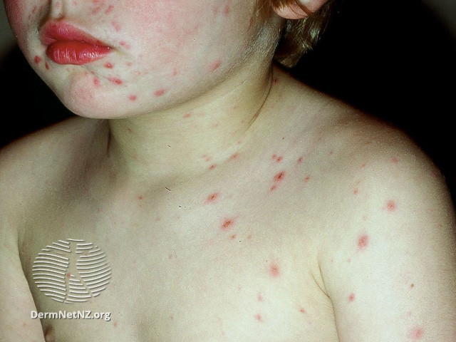File:Chickenpox (DermNet NZ viral-varicella103).jpg