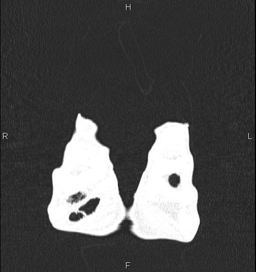 Chilaiditi sign (Radiopaedia 88839-105611 Coronal lung window 1).jpg