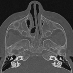 Choanal atresia (Radiopaedia 88525-105975 Axial bone window 38).jpg